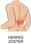 Herpes Zoster Gürtelrose besprechen